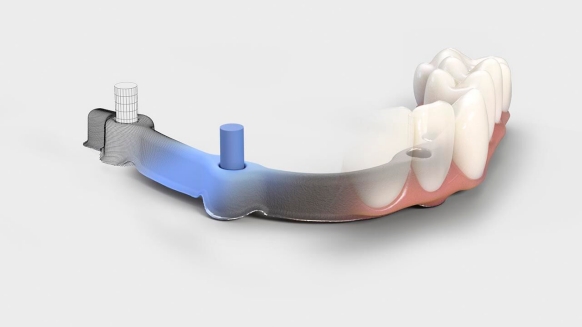 Patient-specific suprastructures beyond CAD/CAM