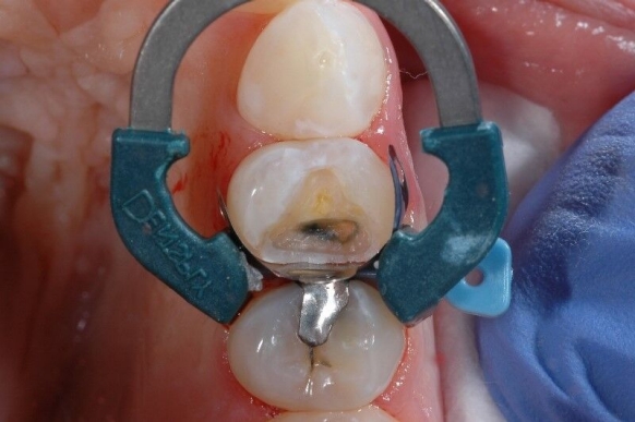 Verwendung des Palodent V3 Teilmatrizensystem mit Kunststoffkeil