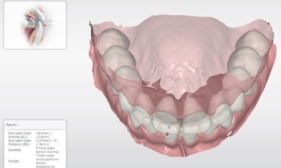 CEREC Ortho SW 2.1 - measurement automation