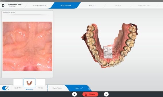 Acquisition Phase CEREC SW 5.1