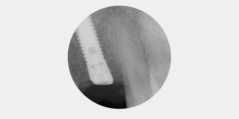 Nach distal abgeschrägter Alveolarkamm. 