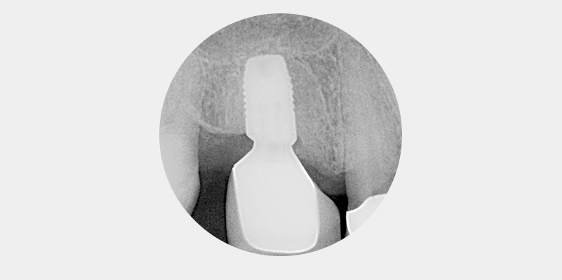 Nach distal abgeschrägter Alveolarkamm. 
