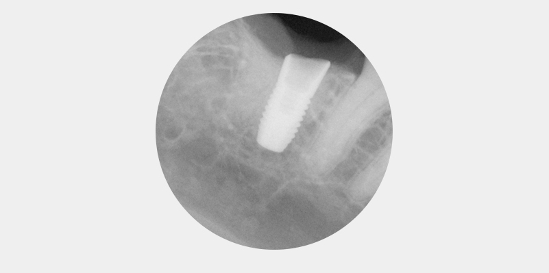 Nach distal abgeschrägter Alveolarkamm.