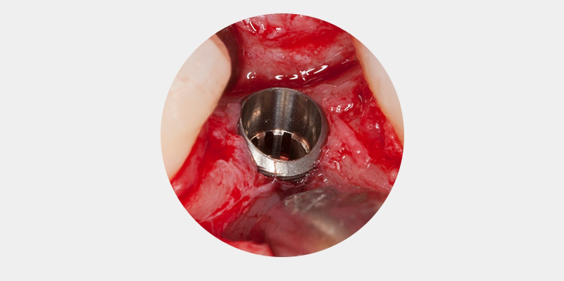 Enger Alveolarkamm im Seitenzahnbereich des Unterkiefers. 