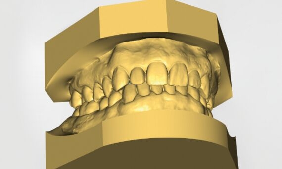 CEREC Ortho modelo digital 