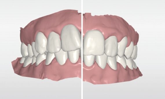 Comparación de Antes y Después con CEREC Ortho