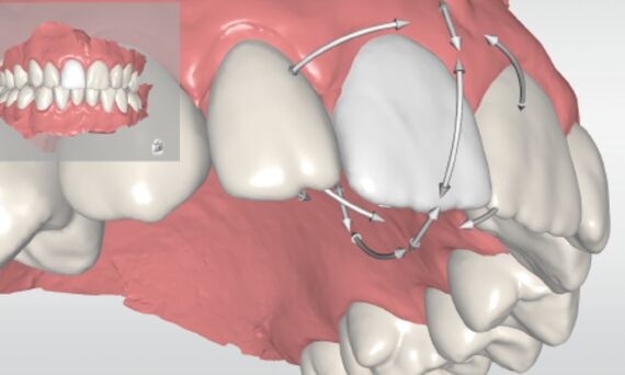 Movimiento de un solo diente con CEREC Ortho
