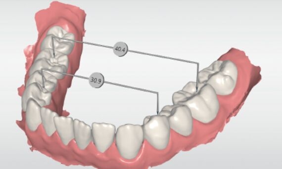 Medición de distancia entre dientes