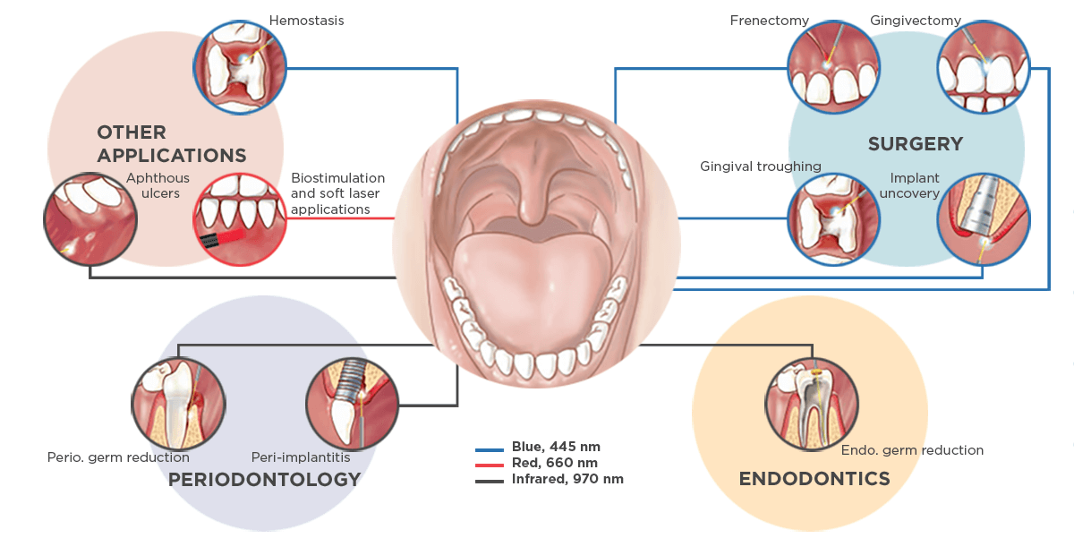Treatment options with SiroLaser Blue