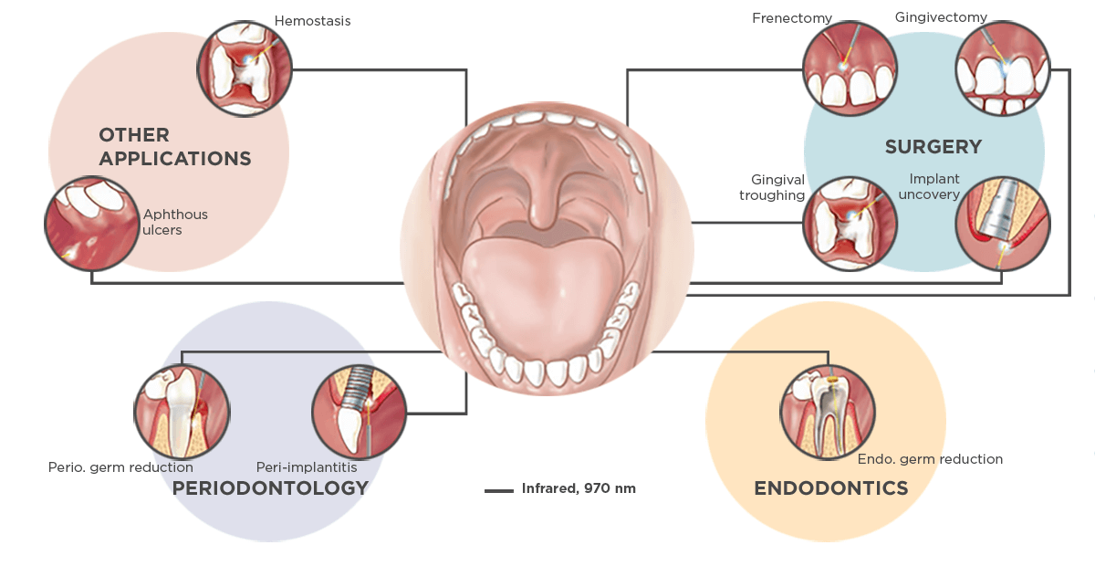 Treatment options with Sirolaser Advance & Sirolaser Xtend