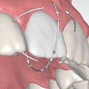 Single tooth movement with CEREC Ortho