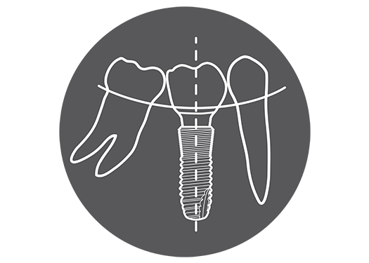 Guided surgery