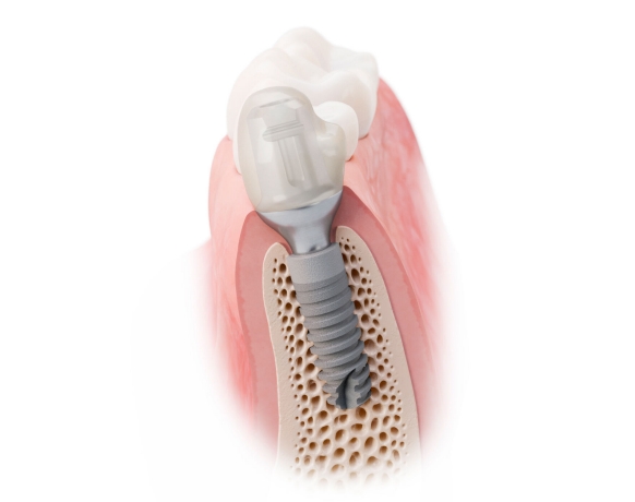 Ankylos Soft Tissue Chamber