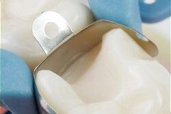 Klasse II dentale matrix plaatsing van Palodent V3 sectionele matrix door Dentsply Sirona, waar de tand een anatomisch, natuurlijke contour heeft.