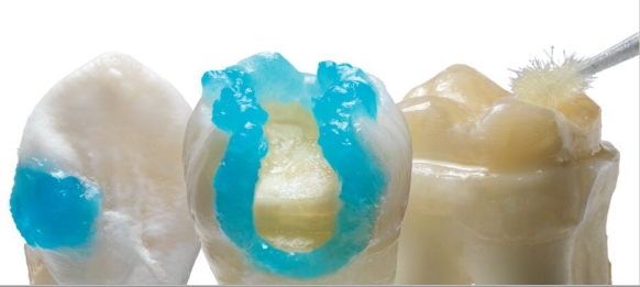 Klasse II restauratief adhesief, bijvoorbeeld Prime&Bond Active tandheelkundig adhesief van Dentsply Sirona.