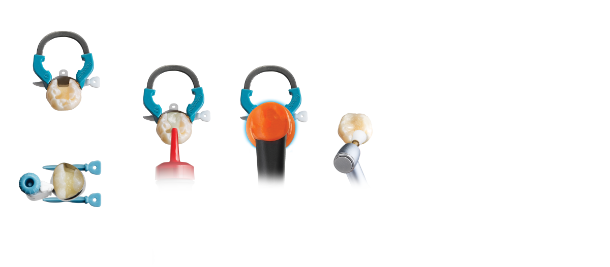 De gestroomlijnde Class II Solution™ voor uw gehele praktijk om uitdagende Klasse II tandheelkundige restauratieprocedures uit te voeren met producten van Dentsply Sirona.