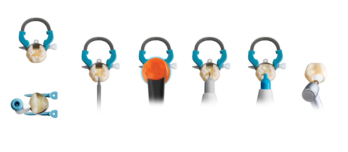 De standaard Klasse II tandheelkundige restauratieprocedure met producten van Dentsply Sirona.